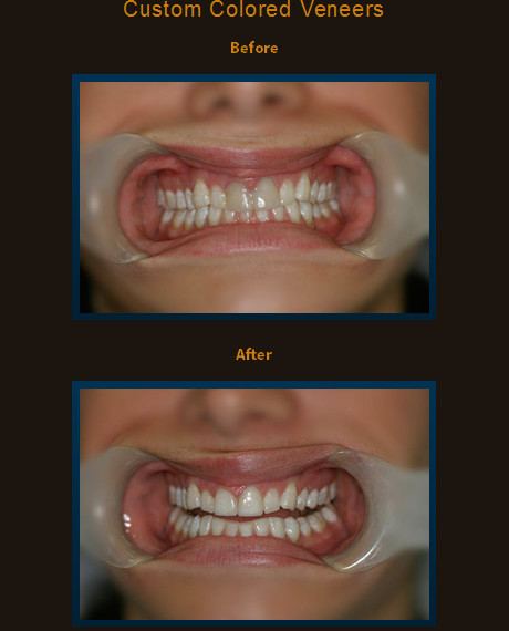 We added two custom colored Laminates to blend with the natural speckled appearance to blend with calcium deposits on the surrounding teeth.